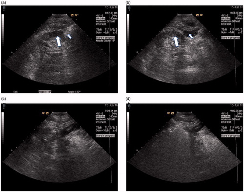 Figure 1. (a) US scan during ablation with tumor (thick arrows) adjacent to the bowel (thin arrow) that distance between tumor margin and renal pelvis <5 mm as measured by US. (b) US scan local separation of the liquid (thin arrow) between the tumor (thick arrows) and the bowel during hydrodissection. (c) US scan during ablation antenna was percutaneously inserted into the tumor and placed at the desired location. (d) US scan during ablation the heat-generated hyperechoic water vapor did completely encompass the entire tumor.