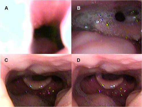 Figure 5 Drug-induced sleep endoscopy results at the oropharyngeal level: supine position. No intermittent negative airway pressure (iNAP) therapy during (A) inspiration and (B) expiration. Application of iNAP therapy during (C) inspiration and (D) expiration.