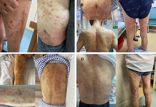 Figure 1 (A) On admission, urticarial erythema and papules on the trunk and extremities. Isolated tense blisters and bullae on the abdomen and bilateral thighs (B and C) erythema on the back and lower limbs progressed, with more new vesicles continuing to appear on the legs. (D) Erythema transformed into hyperpigmentation.