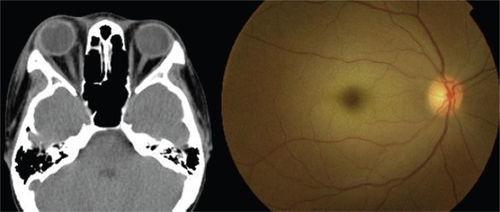 Figure 2 Postoperative computed tomographic image and fundus photograph. Left: Postoperative computed tomographic image of axial section. Blow-out fracture has been corrected and the eyeball is returned to the proper position. right: Fundus photograph of right eye showing a cherry-red spot, milky-white lesion on macula, and mild venous dilation.