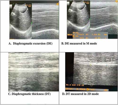Figure 1. M-mode and 2D-mode ultrasonographic images of diaphragmatic function.A, B: Diaphragmatic excursions (D) Ein 2D, and M-ModesC, D: Diaphragmatic thickness (DT), and thickening fraction in 2D -Mode