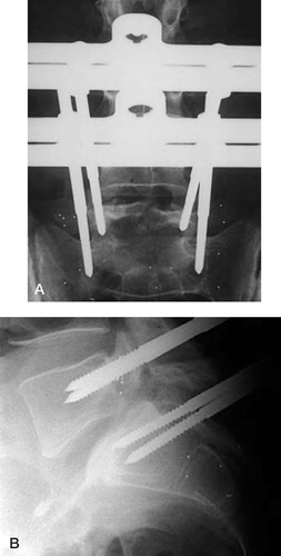 Figure 3:2 Tantalum indicators for radiostereometry implanted into the bases of the two transverse processes of the spondylolytic fifth vertebra and in the lateral masses and the central portion of the sacrum. Two pedicular screws are placed on each level. A. Anteroposterior view. B. Lateral vew. (Reproduced with permission from Spine).
