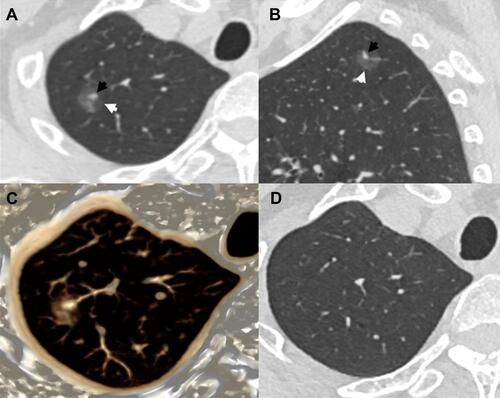 Figure 4 A patient with a transient type I GGN. He had blood eosinophilia (eosinophil count, 620/ul). Axial (A) and sagittal (B) CT images show a 13.7 mm oval mixed GGN located in the right upper lobe, the internal high-attenuation (black arrow) zone is eccentric, irregular, and blurred, and the peripheral GGO (white arrow) is partly ill-defined. VR image (C) confirm that the internal high-attenuation zone is connected to an adjacent blood vessel. At follow-up CT (D) obtained 2.5 months later, the GGN has disappeared.