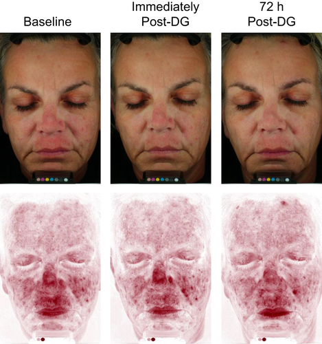 Figure 2 Short-term improvements observed in dry skin 72 hours after DG treatment. Participant pictured was a 55-year-old woman with Fitzpatrick Skin Type II. Photographs under cross-polarized lighting (top) or red channel lighting (bottom) showing improvements in visible redness and skin tone unevenness immediately and 72 hours after DG treatment.