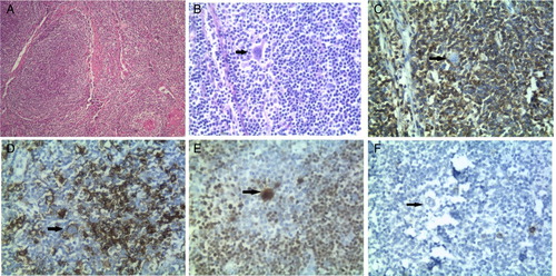 Figure 2. HPE (hematoxylin and eosin stain (H&E)) of right inguinal lymph node biopsy showing microscopic sections: a predominant nodular pattern (A) with morphologically typical Reed-Sternberg cells, the popcorn cells (B) showing positive immunostaining with CD45 (D), CD20 (C), OCT (E) positivity with CD30 negativity and (F) CD 30 negativity is not present.