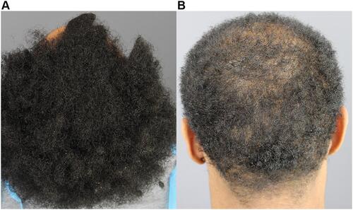 Figure 12 Photographs of patient 10 with type 3 hair grown out long (A) and cut shorter (B).