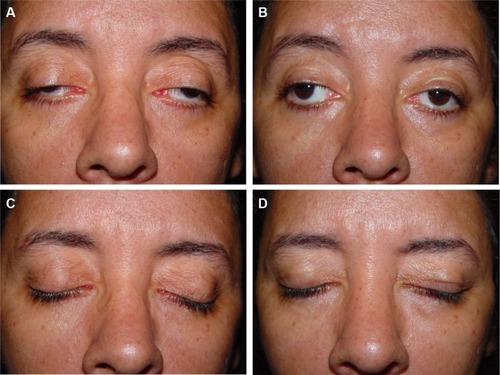 Figure 4 Preoperative and postoperative appearance of a 34-year-old female patient.