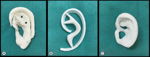 Figure 1. Methods of whole auricular reconstruction.Current techniques (A) rib cartilage and (B) MedPor, and future techniques (C) porous bioscaffold.