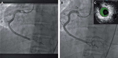 Figure 2. (A) Coronary angiography showing thrombotic occlusion in distal RCA, (B) Coronary angiography of RCA after aspiration thrombectomy. (C) VH assessment of distal RCA showing presence of thrombus with minimal necrotic core (inset).