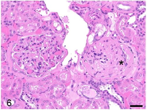 Figure 6. Case 3. Glomerulosclerosis. Glomerular capillaries are markedly thickened and degenerated. The Bowman’s capsule is also markedly thickened (asterisk). Bar = 20 µm.