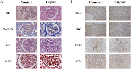 Figure 7. (A) HE, PAS, MASSON, PSAM staining of Lupus Nephritis and normal renal tissue. (B) Targeting gene expression in Lupus nephritis and normal renal tissue through immunohistochemical staining.