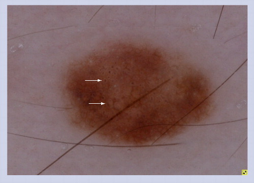 Figure 6. Target network with globules within a congenital melanocytic nevus.