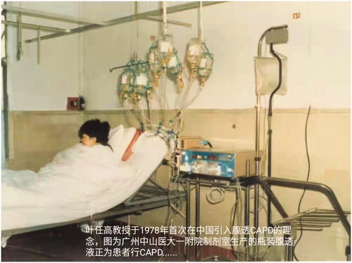 Figure 2. In 1978 Dr. Ye Rengao (叶任高) first introduced the concept and technology of continuous ambulatory peritoneal dialysis (CAPD) into China. This picture showed a patient with renal failure was on CAPD using dialysis solutions in glass containers.
