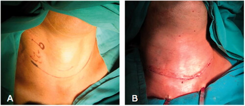 Figure 2. Twelve cases in group A underwent surgery with nasal intubation without undergoing tracheotomy.