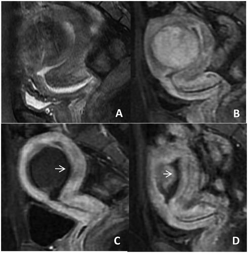 Figure 2. Pre-HIFU, post- HIFU and follow up HIFU MRI images obtained from a patient with type 2 submucosal fibroid. (A) The fibroids were located under the mucosa of the anterior wall of the uterus, with low signal intensity on T2WI(Funaki II); (B) Significant enhancement on T1WI; (C) 100% of the fibroids were ablated after HIFU, there is no enhancement in the mucosa of the fibroids; Endometrium impairmen grade 3(arrow); (D) 3 months after HIFU, FVSR was 90%, 100% enhancement of mucosa in fibroids. Endometrium impairmen grade 0(arrow).