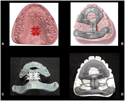 Figure 8 Lab work for MSE. (A) Virtual model with the final position of MSE after digital planning. (B) Digital design of positioning guide. (C) Fixation of the MSE appliance in the positioning guide with steel ligatures. (D) Positioning of the MSE appliance on the dental stone model by means of the resin guide for bending and welding of MSE arms.