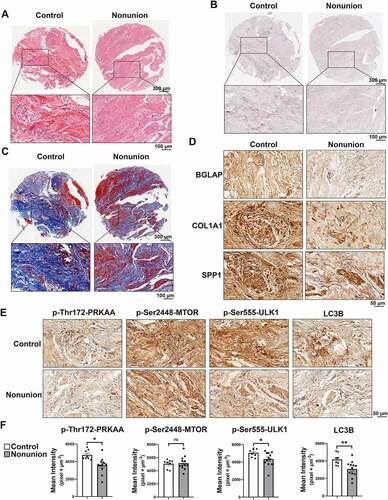 Figure 7. Suppression of the AMPK-ULK1-autophagy axis is relevant to patients with nonunion. (A) Representative H&E staining from control and nonunion groups; scale bar: 300 µm (squares: magnification zones, scale bar: 100 µm). (B) Representative ALP staining from control and nonunion groups; scale bar: 300 µm (squares: magnification zones, scale bar: 100 µm). (C) Representative Masson’s trichrome staining from control and nonunion groups; scale bar: 300 µm (squares: magnification zones, scale bar: 100 µm). (D) Representative immunohistochemistry of BGLAP, COL1A1, and SPP1 in mesenchymal tissues from the control and nonunion groups; scale bar: 50 µm. (E) Representative immunohistochemistry of p-Thr172-PRKAA, p-Ser2448-MTOR, p-Ser555-ULK1, and LC3B from the control and nonunion groups; scale bar: 50 µm. (F) Quantitative analysis of the immunohistochemistry in E (n = 8 in the control group and n = 12 in the nonunion group). Data were presented as mean ± SEM. *P < 0.05 versus control; **P < 0.01 versus control; ***P < 0.001 versus control tested by unpaired Student’s t test.