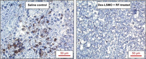 Figure 6 Effect of RF induced Dex-LSMO nanoparticles-mediated hyperthermia treatment on tumor proliferation.Notes: Representative photomicrographs of Ki-67-stained tumor sections of saline control and Dex-LS MO + RF-treated mice.Abbreviations: Dex-LSMO, dextran-coated lanthanum strontium manganese oxide; RF, radiofrequency.