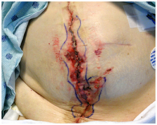 Figure 1 Example of a superficial site infection with necrotic margins.