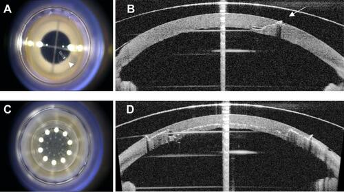 Figure 1 Surgical microscopy and integrated optical coherence tomography images of tunnel and mushroom FSL incisions. Frontal view of the tunnel incision in the paracentral position at 130° (A, arrowhead); plane 1 is angulated while plane 2 lies parallel to the corneal surface (B, arrow); the cut of the internal layers is clear from the frontal view (C); anterior, middle, and posterior view of the lamellar cut following mushroom configuration (D).