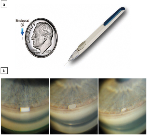 Figure 4. Bimatoprost Sustained Release (Bimatoprost SR) implant. (a) (Right): represents the implant injector system and (left) shows the implant with a dime coin for size comparison. (b) Gonioscopic photographs of Bimatoprost SR implant 10 μg in the anterior chamber of the eye of a glaucoma patient (note the swelling and degradation of the implant during therapy) (Left) 2 weeks, (Centre) 9 months, and (Right) 12 months after injection [Citation54].