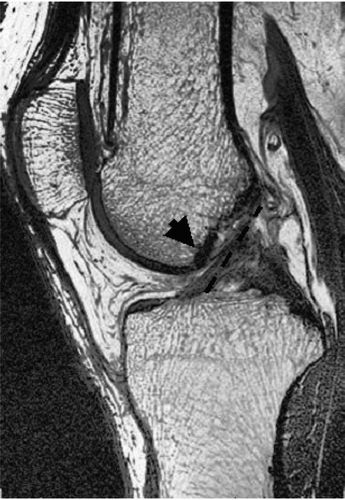Figure 6 MR image of the orientation of the ACL in a human subject in a relaxed, fully extended position. The arrow shows ACL contact with the intercondylar notch. The dashed line indicates an ACL graft orientation that is more vertical than that of ACL fibers