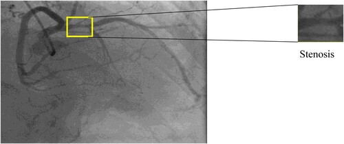 Figure 5. Left artery image with marked stenosis location.