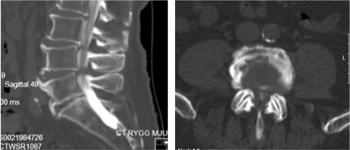 Figure 9. CT myelography of the spine revealing spinal stenosis at the L4–L5 level.