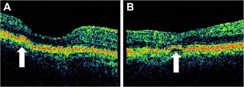 Figure 7 Stratus optical coherence tomography image.