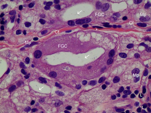 Figure 9 H&E staining of FGC (400× magnification). Very thin new collagen fibers (Cf) were observed in the dermis between two FGCs and these finding showed collagen fibers were continually created as inflammation processes, if foreign body materials (CaHA particles) existed. Foamy (from 12 o’clock to 3 o’clock) FGCs ingested CaHA particles (white arrows). FGC nuclei were peripherally placed and were overlapping each other. Numerous fibroblasts (*), macrophages (Mp), and lymphocytes (L) were found around FGCs.