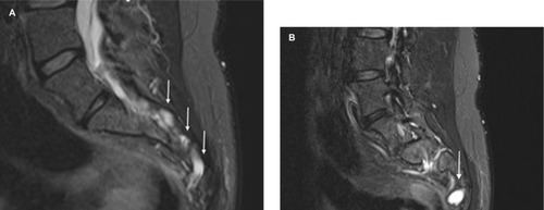Figure 3 (A) Sacral nerve root sheath dilations can be observed, and these appear to be very similar to the optic nerve root sheath dilations. (B) A more lateral view of the sacrum showing significant dilation (Tarlov cyst) of nerve root S3.