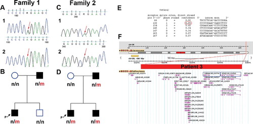 Figure 1. (a) Electropherogram of family 1 with detected heterozygous splice-site mutation c.1526-2A>G, located at the splice-acceptor site of intron 13: (a1) patient 1 sequence; (a2) reference sequence. (b) Pedigree of family 1; n, normal allele; m, mutated allele. (c) Electropherogram of family 2 with detected heterozygous missense c.998G>A mutation in exon 7 of KCNQ2: (c1) patient 2 sequence; (c2) reference sequence. (d) Pedigree of family 2; n, normal allele; m, mutated allele. (e) Putative canonical splice sites near the c.1526-2A>G mutation (NetGene2 prediction tool). (f) Gene content of the deleted region on 20q13.33 (chr20:63045847-63456499, GRCh38/hg38) in patient 3 based on the Database of Genomic Variants (http://dgv.tcag.ca/dgv/app). The rectangle represents the range of the deletion.