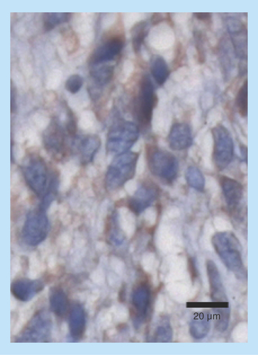 Figure 6.  The proapoptotic transcription factor CHOP/GADD153 may be sequestered in the cytosol in some brain tumors.CHOP may be induced by the PERK arm of the UPR (Figure 1). Shown is an immunohistochemical stain for CHOP on 5 μm paraffin sections of a D245MG GBM xenograft tumor (IHC details are in Epple et al. [Citation12]). Counterstain is hematoxylin/eosin (resulting in blue nuclear staining, while brown staining is for the CHOP protein). Nearly all of the nuclei are spared of the immunostain, suggesting that CHOP cannot enter the nuclei.
