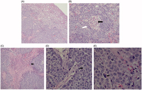 Figure 4. Histopathological findings for the VX2 tumor in HE staining. (A) The tumor cells were nest-arranged and invaded the normal renal parenchyma. (B) Residual glomerulus (black arrow) was destroyed partially by tumor cells (white arrow). (C) Coagulation necrosis was found in the center of the cancer nest. (D) Pathological mitotic figures of tumor cells could be seen (black arrow). (E) Tumor giant cell was found (black arrows).