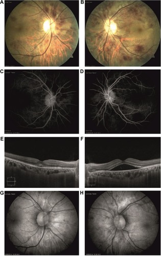 Figure 2 One month after presentation, BCVA was 20/32 in the right eye and 20/100 in the left eye.