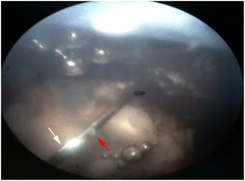 Figure 3 Enlarged view of the NDN tip after being inserted into the vitreous cavity of the cadaver pig eye (imaging performed with an E4 Ophthalmic Endoscopy System Endo Optiks®). Light reflection depicts closed front opening (white arrow). Red arrow indicates side port of the NDN. (Created by L. Lytvynchuk.)