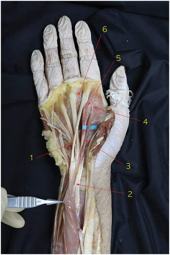 Figure 2. Dissection of the right wrist in the same cadaver with Figure 1. 1. Tendinous portion of flexor digitorum superficialis to the index finger, 2. Origin of the accessory first lumbrical muscle in a tendinous form, 3. Accessory first lumbrical muscle bundle, 4. Tendinous portion of the accessory first lumbrical muscle, 5. first lumbrical muscle, 6. Second lumbrical muscle.