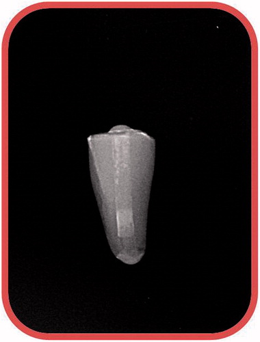 Figure 1. Radiographs were taken in order to confirm complete filling of the canals.