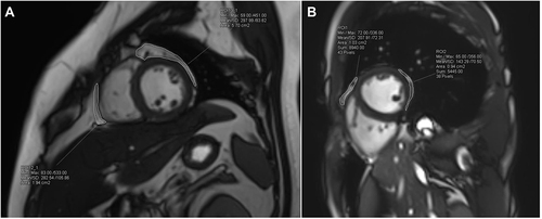 Figure 2 EAT volume calculation in CMR. The EAT region is delineated on short-axis cine slices at end-diastole, from the upper slice limit, marked by the bifurcation of the pulmonary trunk, to the most apical slice. EAT volume is calculated by summing the EAT volume of each slice (8 mm thickness). Representative outputs of EAT delineation in NAFLD patients with and without LVDD are shown in (A and B), respectively.