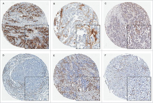 Figure 1. PDL1, PDL2, PD1, CD3 and CD8 expression in gastric carcinoma by immunohistochemistry (× 200). PDL1 expression was evaluated based on staining in the cytoplasm and membrane of tumor cells and immune cells. A: Intense expression of PDL1 in tumor cells; B: Immune cells expressing PDL1 in the disseminated lymphocytes and macrophages; C: representative cytoplasmic expression of PDL2 in tumor tissues. D: PD1 expressed in the disseminated immune cells infiltrating the tumor tissues; E: The representative images of CD3+ T cells; F: The representative images of CD8+ T lymphocytes.