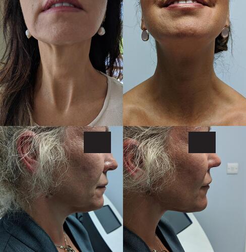 Figure 5 Clinical photos showing the lifting effects of PLCL threads. Patient A: The patient presented with laxity in the soft tissue of the anterior neck and was shown to have lasting lift up to the 9th month after insertion. Patient B: The patient had ptosis of the soft tissue around the jaw line and neck; the effect is seen even after 12 months.