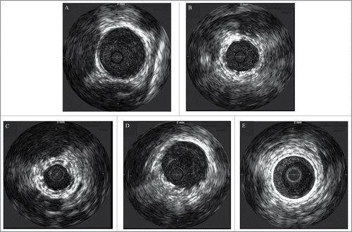 FIGURE 2. Intravascular images of the vessels before stent implantation (A), implanted with Igaki-Tamai stents (B, C) and bare metal stents (D, E) immediately after stent implantation (B, D) and 6 weeks after stent implantation (C, E).