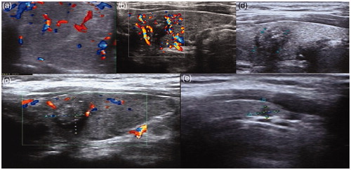Figure 4. US scans in a 30-year-old woman: (a) US reveals a cyst-solid mixed TN. The TN’s volume was 4.1 ml, of which the solid portion was 83.6%. (b) One month after the ablation, the volume of the TN decreased to 2.5 ml with a VRR of about 39.6%. (c) Three months after US-guided PMWA, the volume was 1.2 ml, with a VRR of about 73.8%. (d) Twelve months after US-guided PMWA, the volume was 0.03 ml with a VRR of about 97.6%.