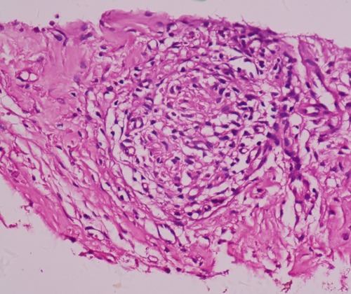 Figure 3 Case 1. CT-guided percutaneous lung biopsy shows caseous necrosis and granulomatosis surrounded by epithelioid and multinucleated giant cells. Hematoxylin and eosin, ×400.