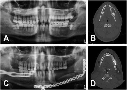 Figure 2. (A, B) A 17-year-old male with 3.4 × 2 cm2 multicystic ameloblastoma of the left posterior mandibular body. Patient consulted 20 months after onset of progressive painless mass. History of high blood pressure treated with two antihypertensive agents. No history of tobacco or alcohol consumption. BMI of 41 kg/m2. (C, D) Ameloblastoma was treated with left segmental mandible resection, non-vascularized bone graft from iliac crest, reconstruction plate and left IAN grafting. No tracheostomy was required. Length of stay of 4 days. No postoperative complications.