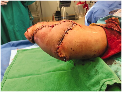 Figure 6. Operative method demonstrating fillet flap closure over stump defect.