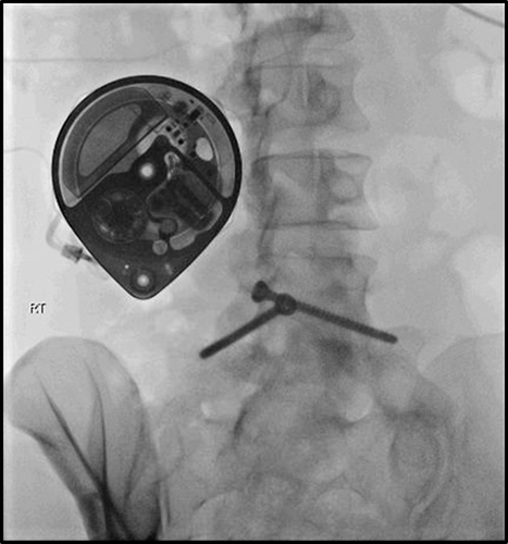 Figure 4 Intrathecal catheter connected to an implanted pump.