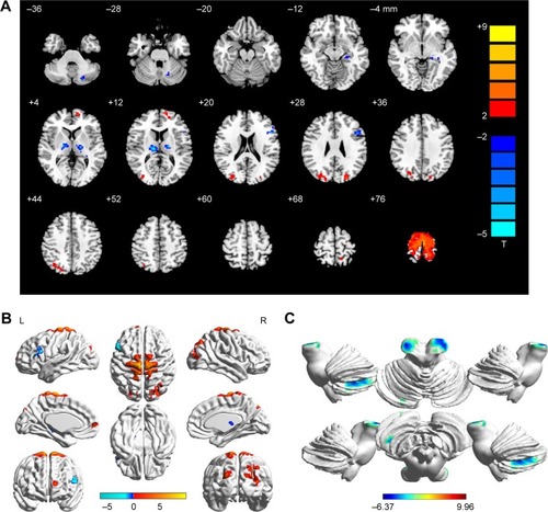 Figure 1 Spontaneous brain activity in the SA and HC groups.