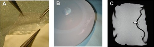 Figure 6 (A) Microsurgical separation of the different shell layers and (B) suture of the outer layer. (C) Low signal intensity line in the high signal intensity silicone gel seen on magnetic resonance imaging after microsurgical separation of the shell layers, mimicking the linguine sign (arrow).