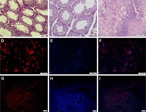 Figure 5 In vivo tumor histological examination and evaluation of decontamination of SSCs from EL4 cells after treatment with CDDP/PLGA NPs.Notes: (A) Histological analysis of busulfan-treated control mice. (B) Normal seminiferous tubules are seen in the group that received EL4 cells and SSCs after treatment. (C) Histological section of tumor formed from EL4 cells alone stained with H&E (bar = 100 μm). Cell labeling of SSCs and transplantation. (D) A cluster of SSCs labeled with DiI, (E) cells labeled with DAPI, and (F) merged. Bar = 100 μm. (G–I) Colonization and proliferation of labeled injected cells (bar = 50 μm).Abbreviations: SSCs, spermatogonial stem cell; CDDP, cis-diaminedichloroplatinum; PLGA, poly(lactic-co-glycolic acid); NPs, nanoparticles.